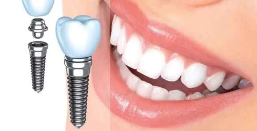 خدمات دندانپزشکی / ایمپلنت/ تعرفه دولتی / ضمانتی|خدمات آرایشگری و زیبایی|کرج, گلشهر|دیوار