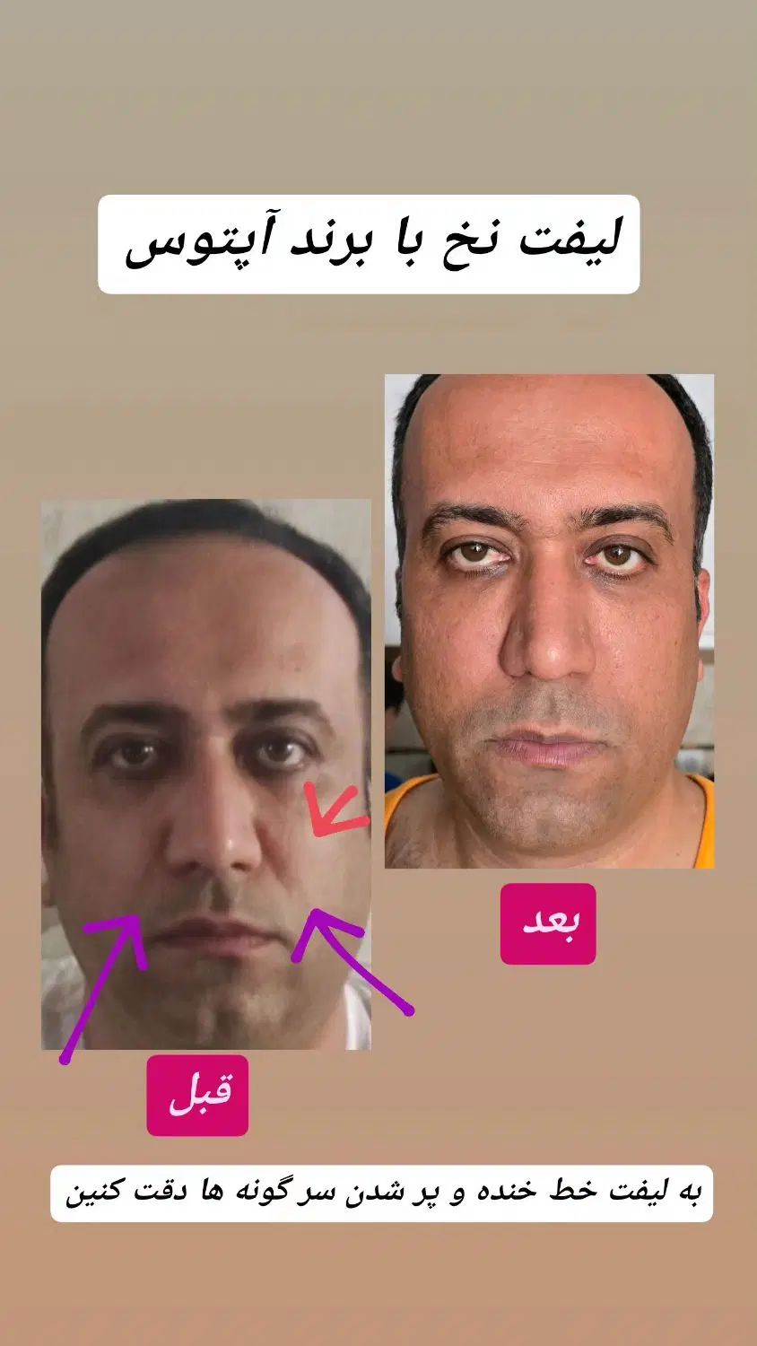 لیفت با نخ|خدمات آرایشگری و زیبایی|اصفهان, باغ زیار|دیوار