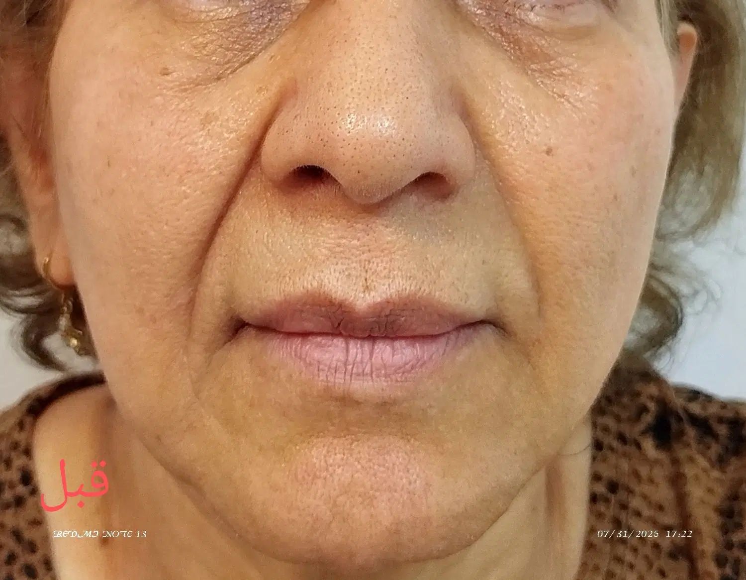 لیفت وجوانسازی قوی صورت|خدمات آرایشگری و زیبایی|رشت, گلسار|دیوار