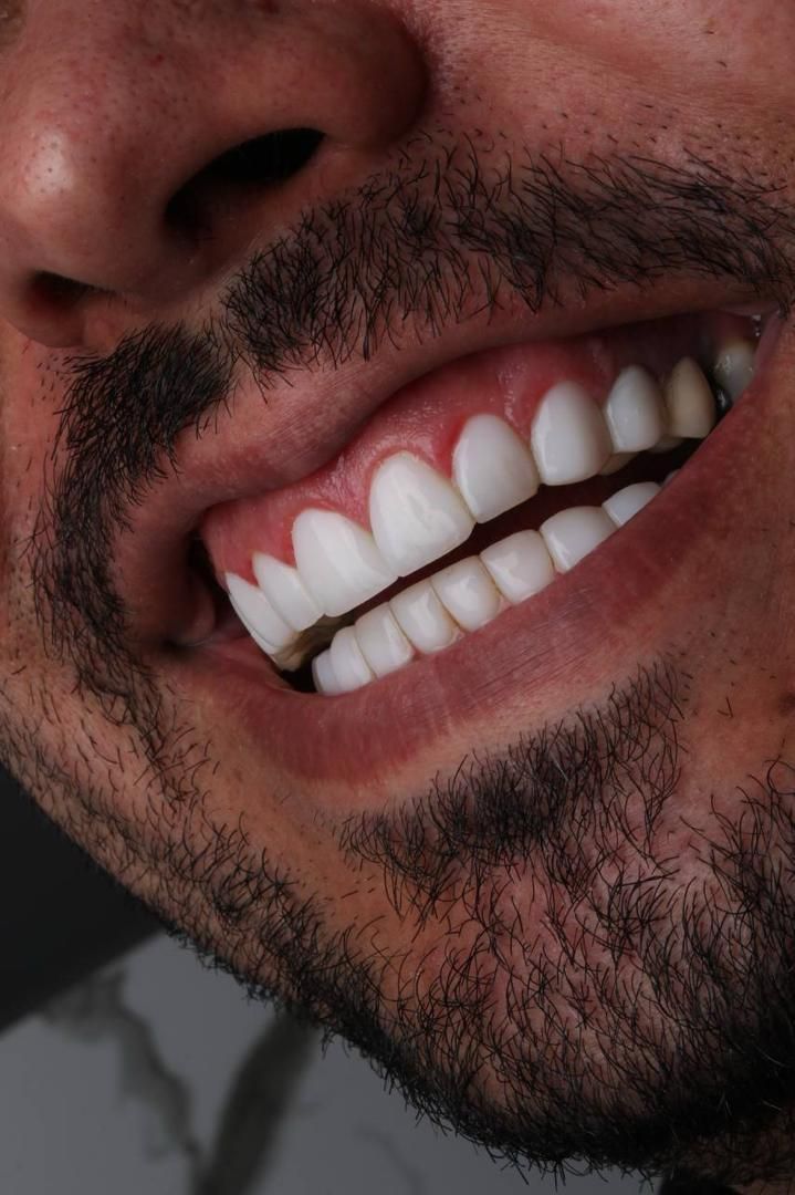 لمینت کامپوزیت ایمپلنت ارتودنسی عصب کشی|خدمات آرایشگری و زیبایی|شیراز, قصرالدشت|دیوار