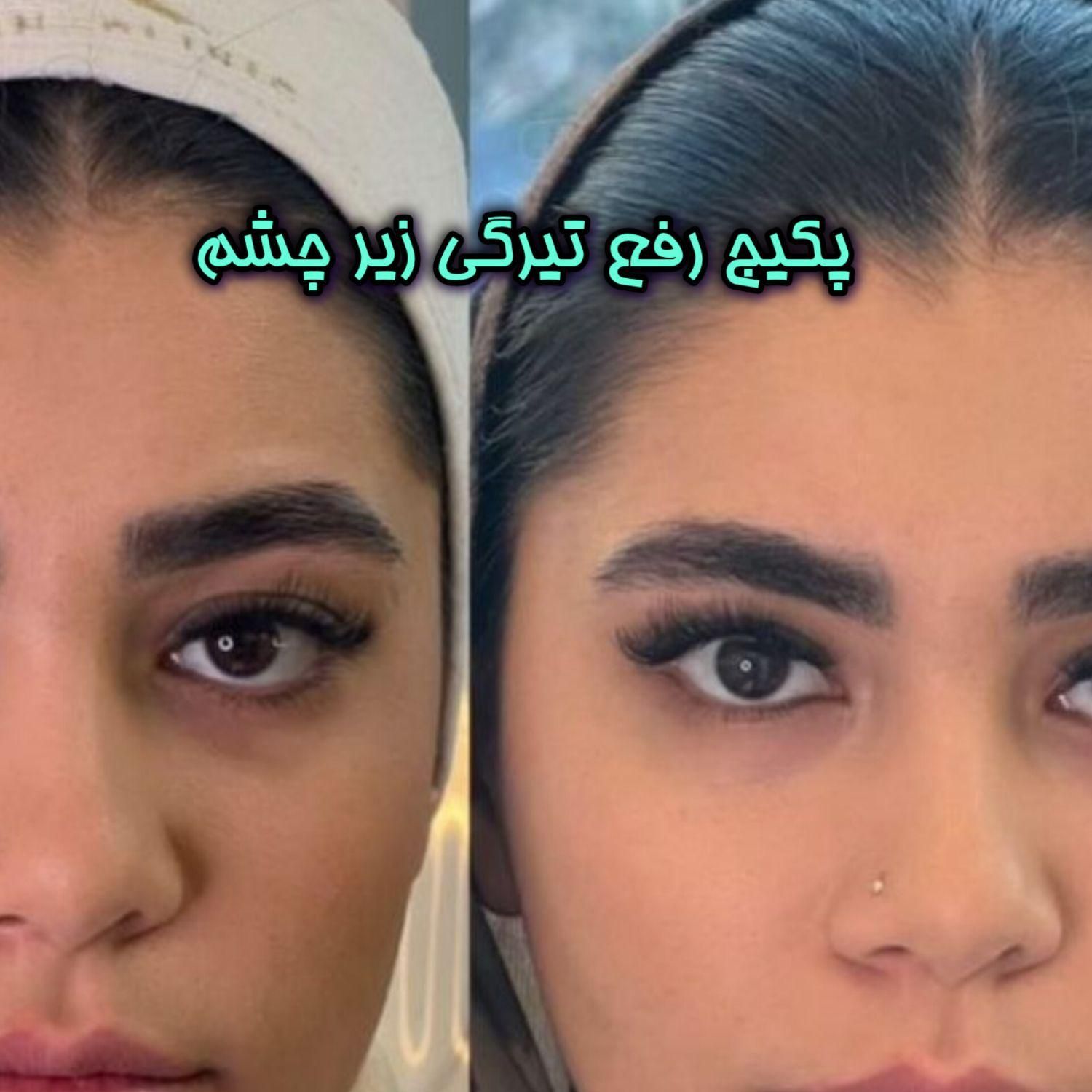 آنزیم ژل فیلر مزو بوتاکس فیشیال لابیا تنگی هودکتوم|خدمات آرایشگری و زیبایی|مشهد, آزادشهر|دیوار
