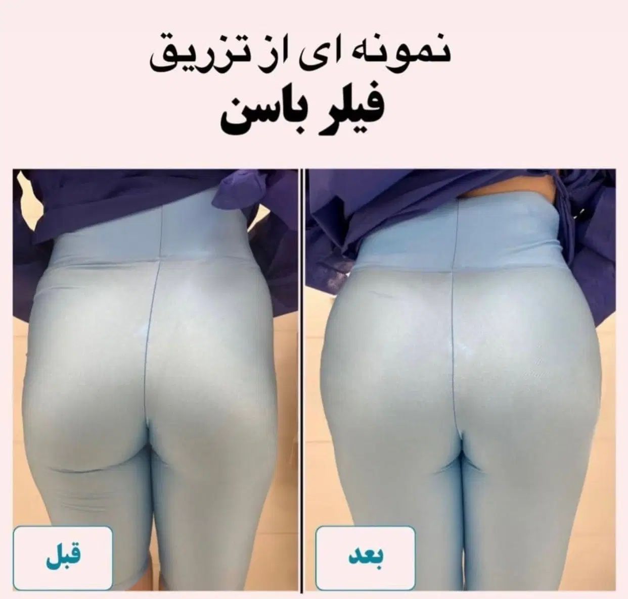 آموزش فیلربادی بامدرک دانشگاه همراه با مدل زدن|خدمات آموزشی|تهران, جردن|دیوار