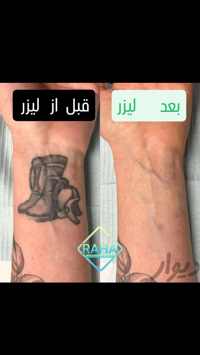کلینیک پاک کردن تاتو(لیزرتضمینی)دریک جلسه/ریموابرو|خدمات آرایشگری و زیبایی|مشهد, احمدآباد|دیوار