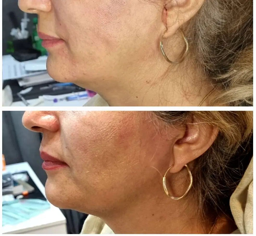 ژل بوتاکس فیلر نخ  فشیال صورت|خدمات آرایشگری و زیبایی|تبریز, |دیوار