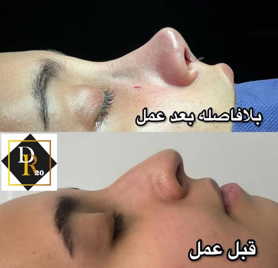 عمل بینی اقساطی با ضمانتنامه کتبی کیفیت|خدمات آرایشگری و زیبایی|شیراز, ملاصدرا|دیوار