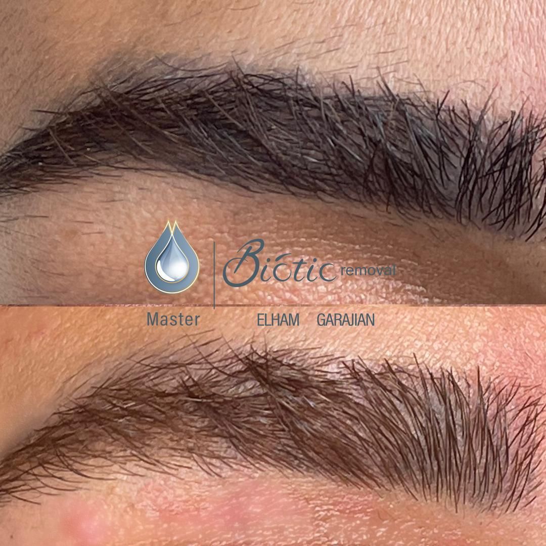 تکنیک ریموو تاتوهای قدیمی صورت و خاویارتراپی|خدمات آرایشگری و زیبایی|نیشابور, باغرود|دیوار