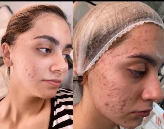 ٪۳۰ تخفیف فشیال و پاکسازی پوست و صورت در کلینیک|خدمات آرایشگری و زیبایی|قم, پردیسان|دیوار