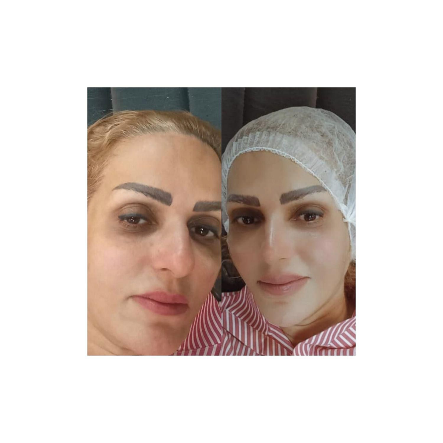 فشیال و پاکسازی پوست با دستگاه ومواد|خدمات آرایشگری و زیبایی|کرج, آق تپه|دیوار