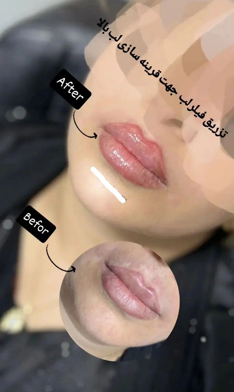 زیبایی ماندگار آرایش دائم / تزریق ژل و بوتاکس|خدمات آرایشگری و زیبایی|شوشتر, |دیوار