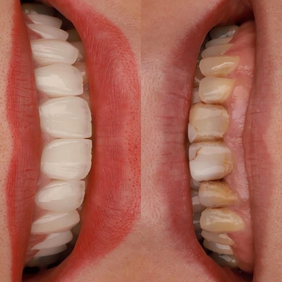 دندانپزشکی ایمپلنت کامپوزیت لمینیت روکش دندان|خدمات آرایشگری و زیبایی|تبریز, |دیوار