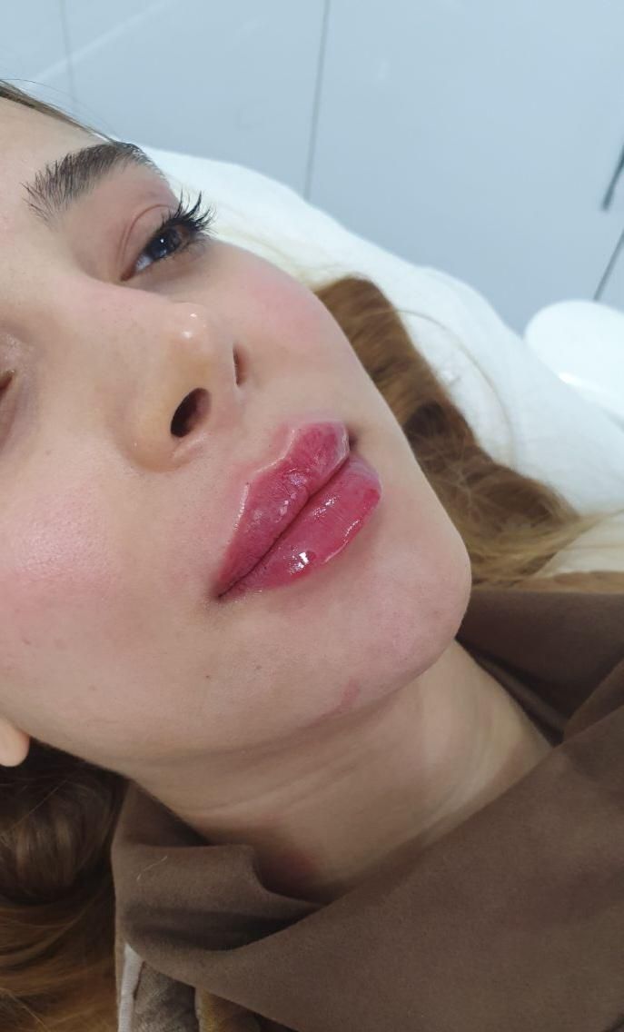 تزریق ژل و بوتاکس و هایفوتراپی پروفایلو فیلر بادی|خدمات آرایشگری و زیبایی|شیراز, فرهنگ شهر|دیوار
