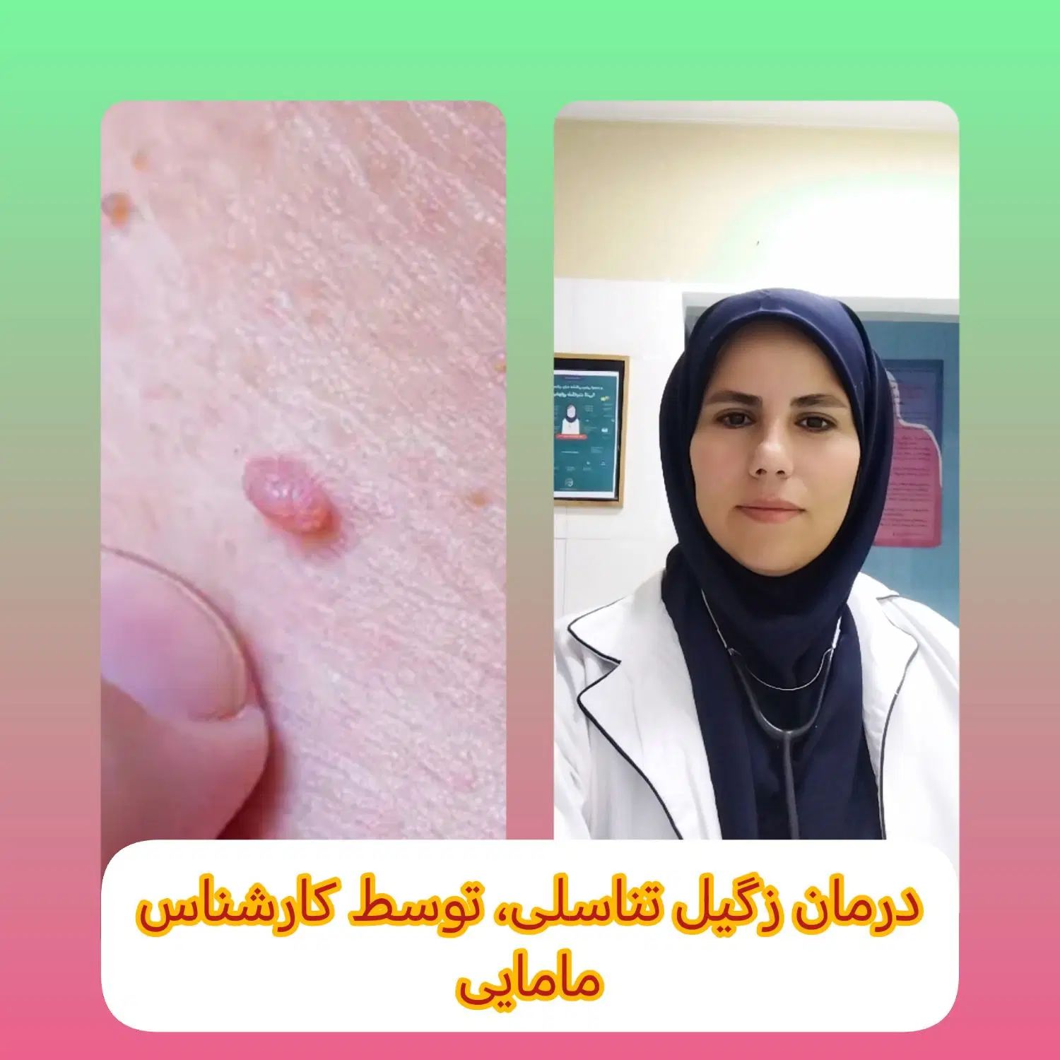 پگ درمان زگیل تناسلی|آرایشی، بهداشتی، درمانی|تهران, چیتگر شمالی|دیوار
