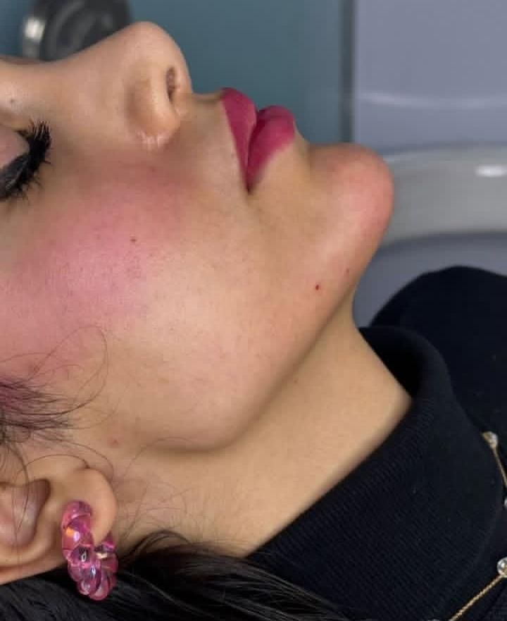 تزریق ژل و بوتاکس لیفت نخ جدیدترین متد مطب زیبایی|خدمات آرایشگری و زیبایی|کرج, گوهردشت|دیوار