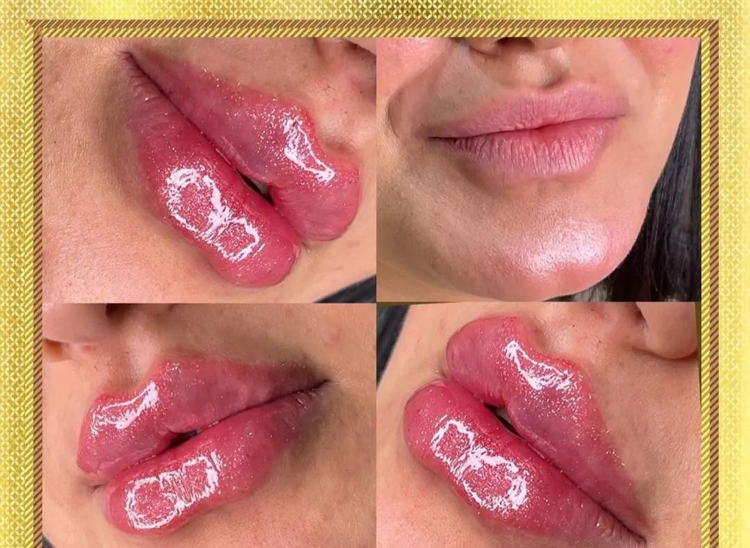 ژل بوتاکس،لابیاپلاستی،حذف لک،ریموو تتو،لاغری|خدمات آرایشگری و زیبایی|ارومیه, |دیوار