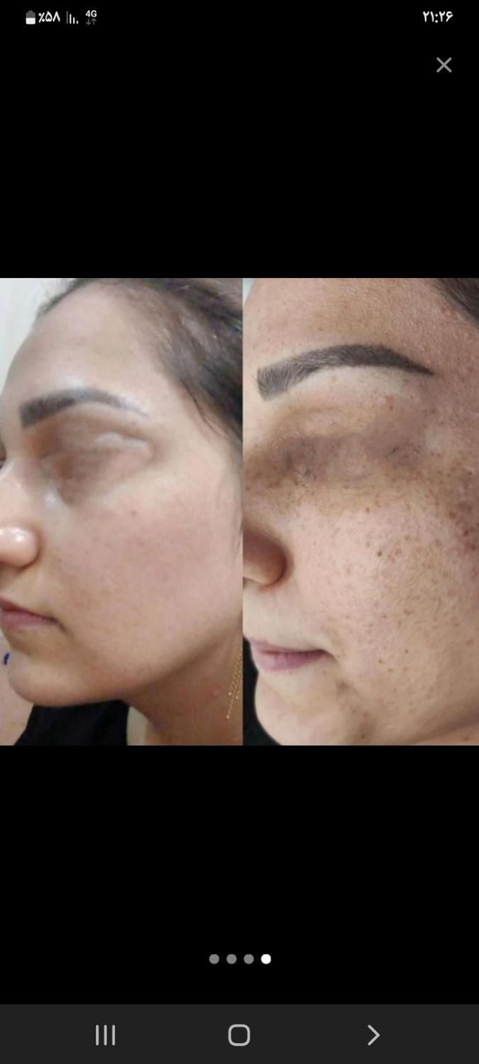 خدمات حرفه ای تخصصی،لک کک مک موی زائدسفیدالکترولیز|خدمات آرایشگری و زیبایی|قم, صفائیه|دیوار