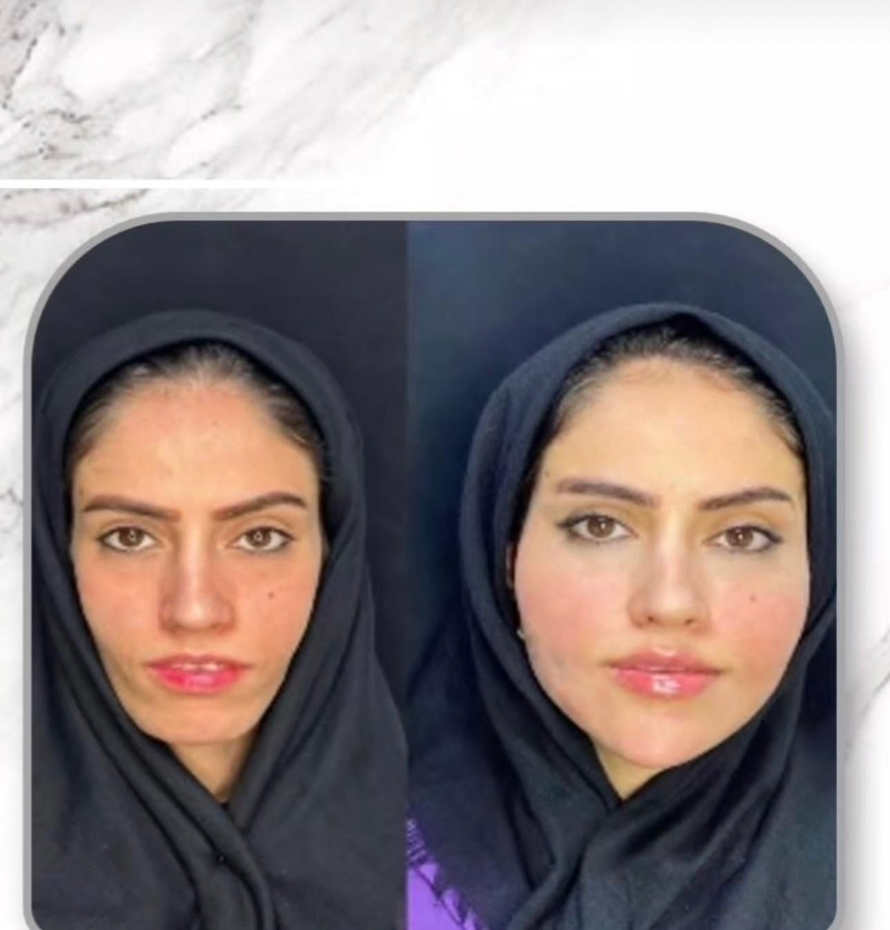لیفت BAU فیس لیفت صورت اصلاح افتادگی لاغری صورت|خدمات آرایشگری و زیبایی|مشهد, هفت تیر (حافظ)|دیوار