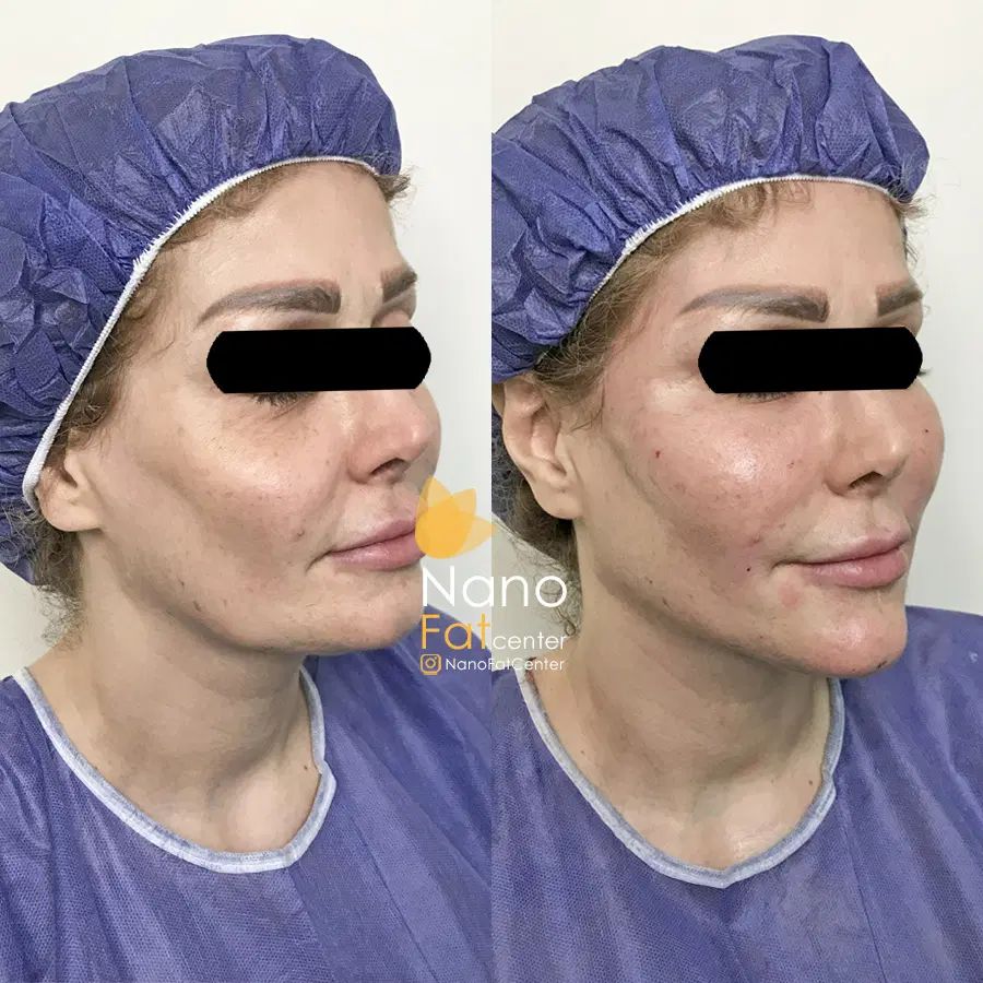 تزریق چربی صورت ماندگاری دائمی روی دست بیکینی باسن|خدمات آرایشگری و زیبایی|تهران, صادقیه|دیوار