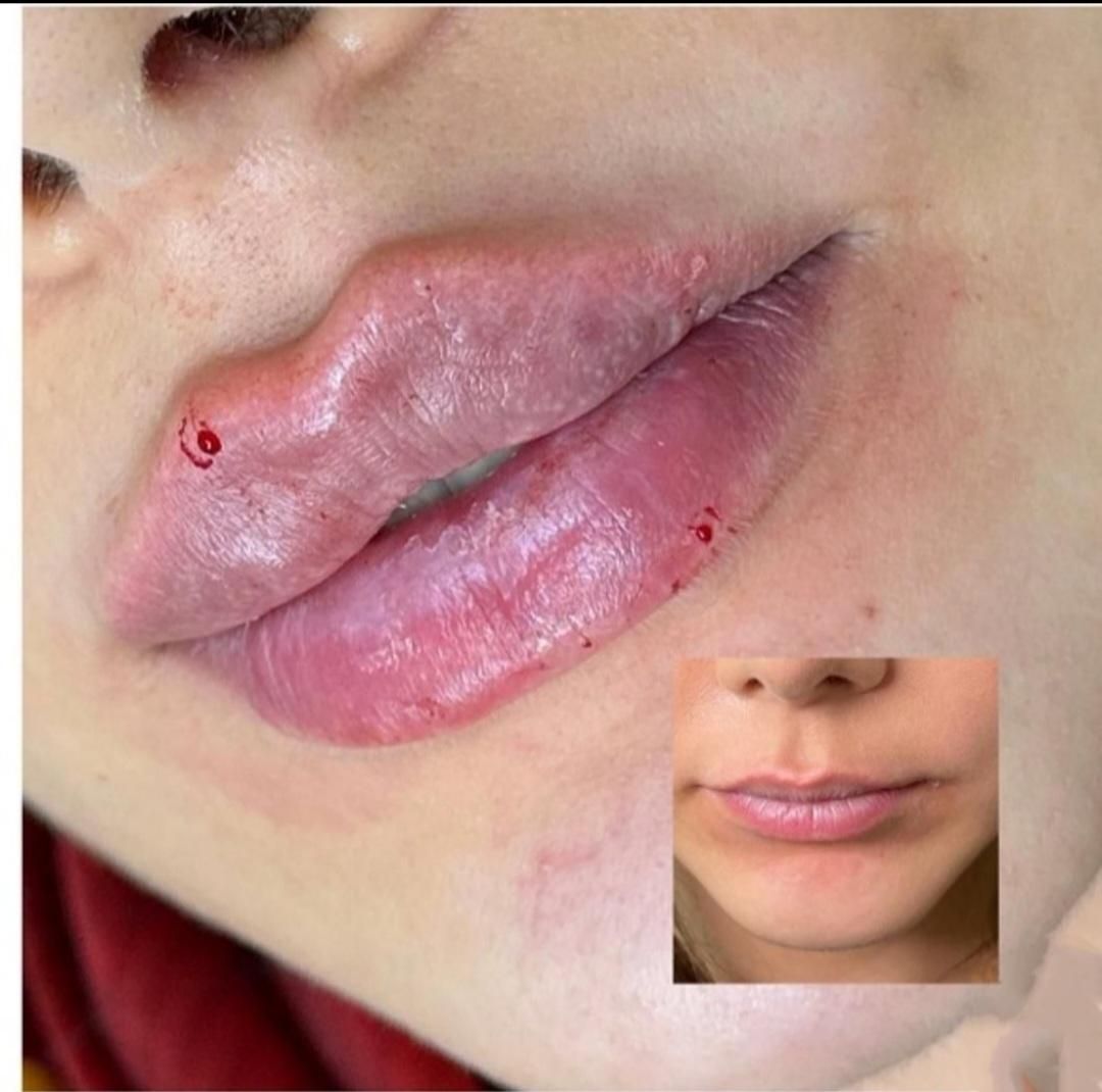 تزریق ژل وبوتاکس|خدمات آرایشگری و زیبایی|پاکدشت, پاکدشت (مامازند)|دیوار