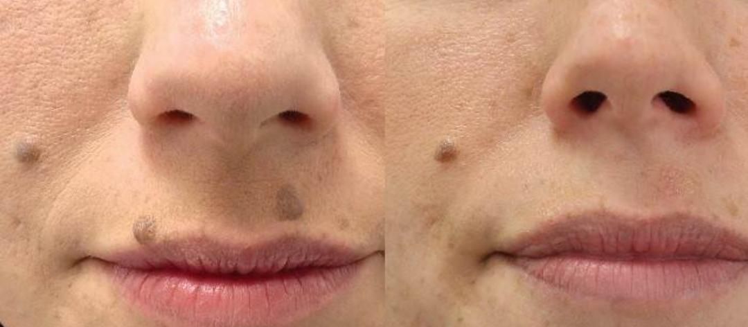 خال برداری و ضایعات پوستی در کلینیک معتبر|خدمات آرایشگری و زیبایی|کرمانشاه, |دیوار