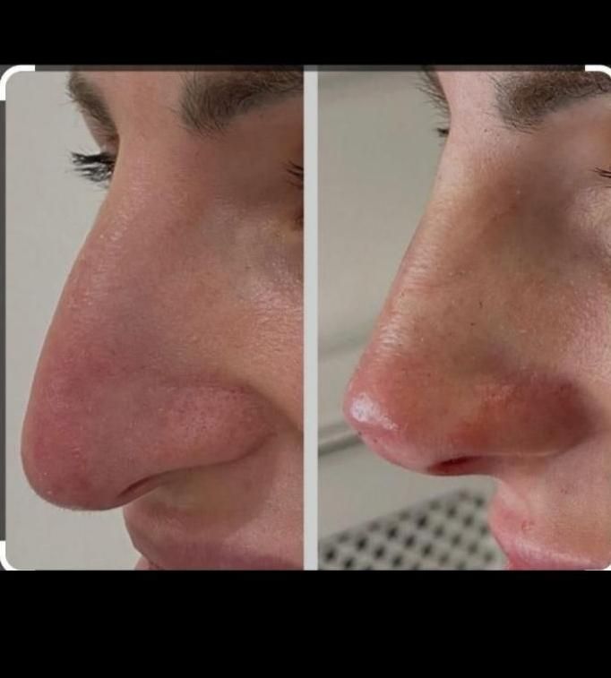 طراحی لیفت بینی وفرمدهی عملی(بدون جراحی)پزشک متخصص|خدمات آرایشگری و زیبایی|مشهد, سناباد|دیوار
