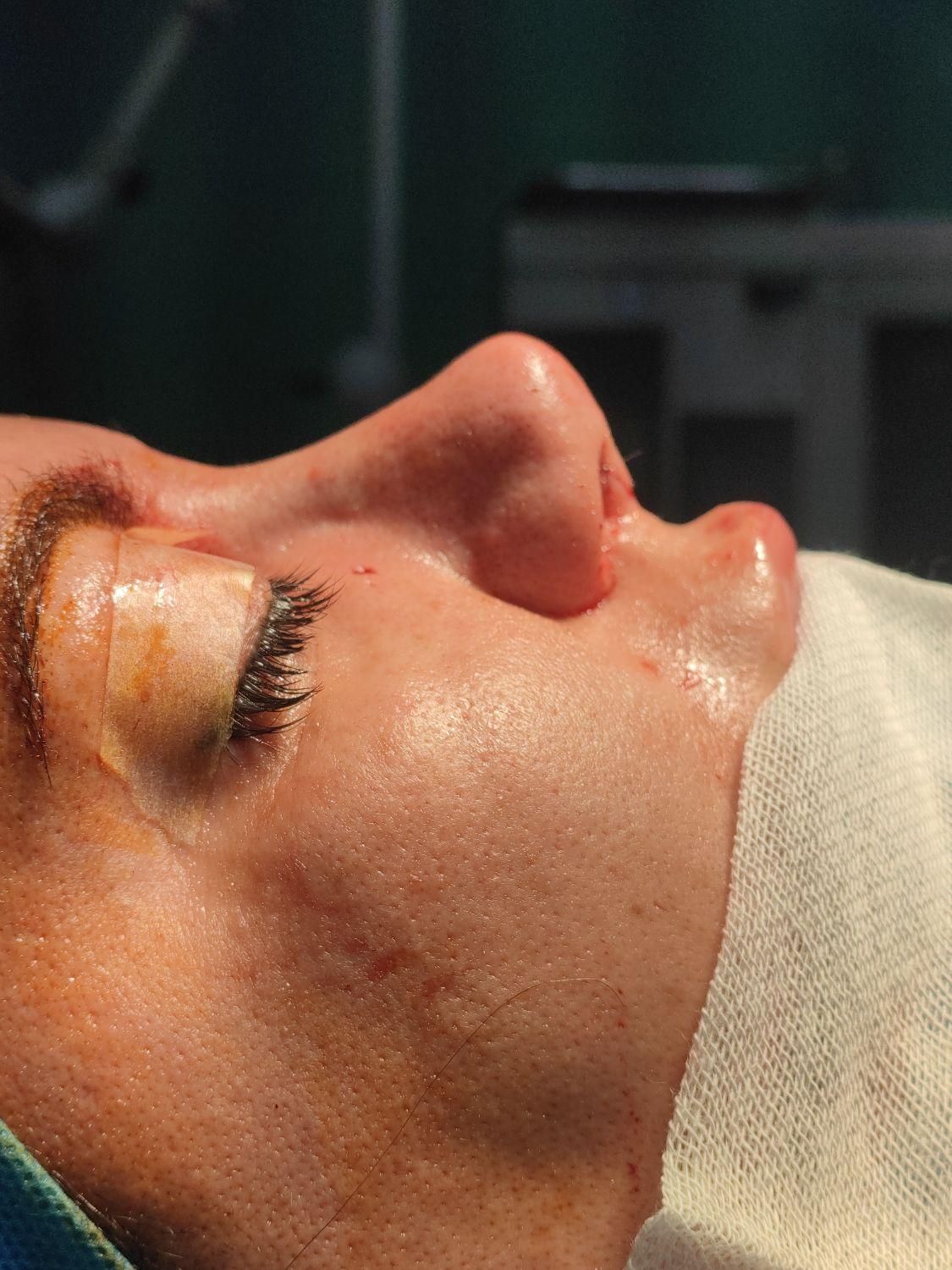 زیبایی بینی۲۹تومن با متخصص گوش و حلق و بینی|خدمات آرایشگری و زیبایی|ورامین, ورامین|دیوار