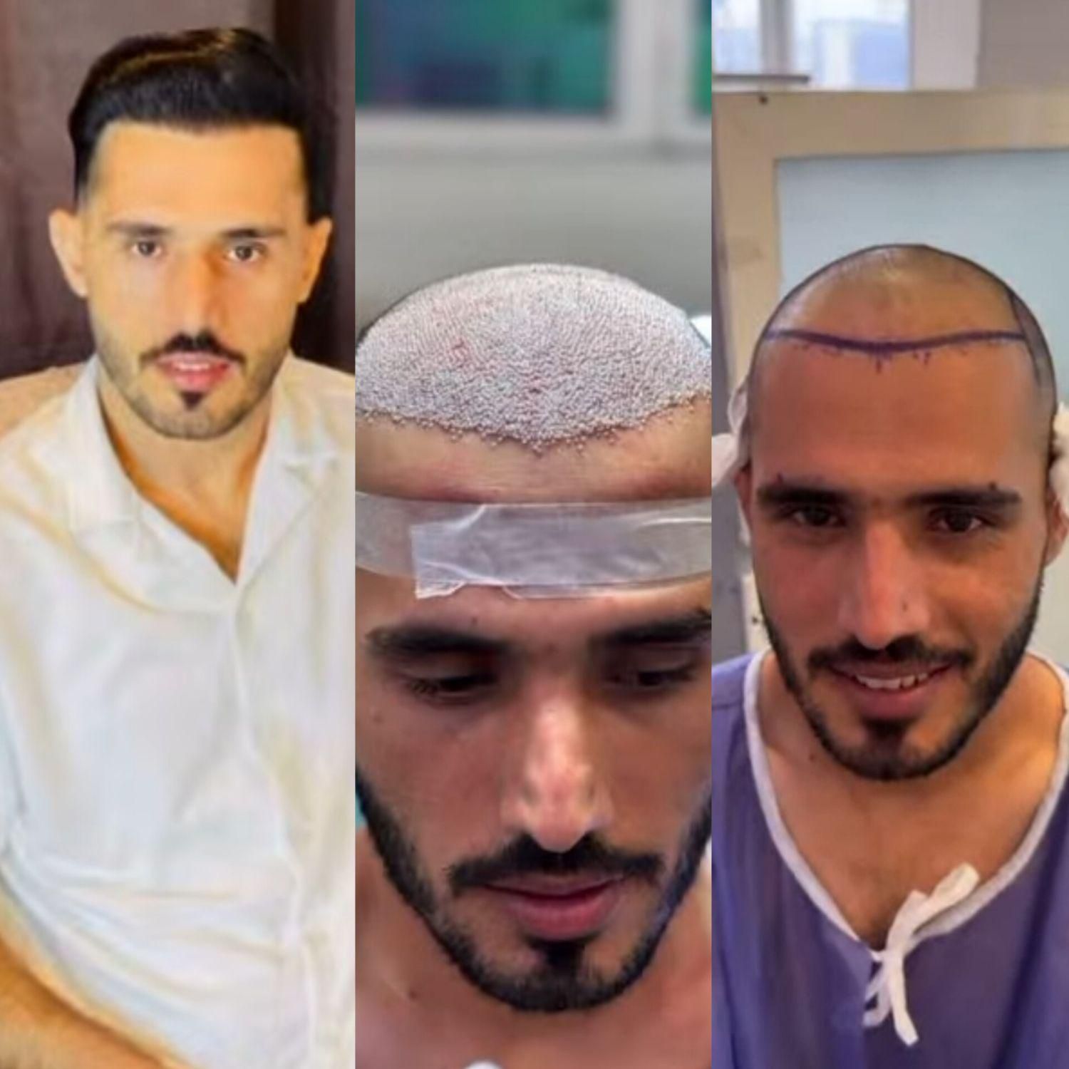 کاشت مو اقساطی باضمانت نامه کتبی مادامالعمر|خدمات آرایشگری و زیبایی|یزد, |دیوار