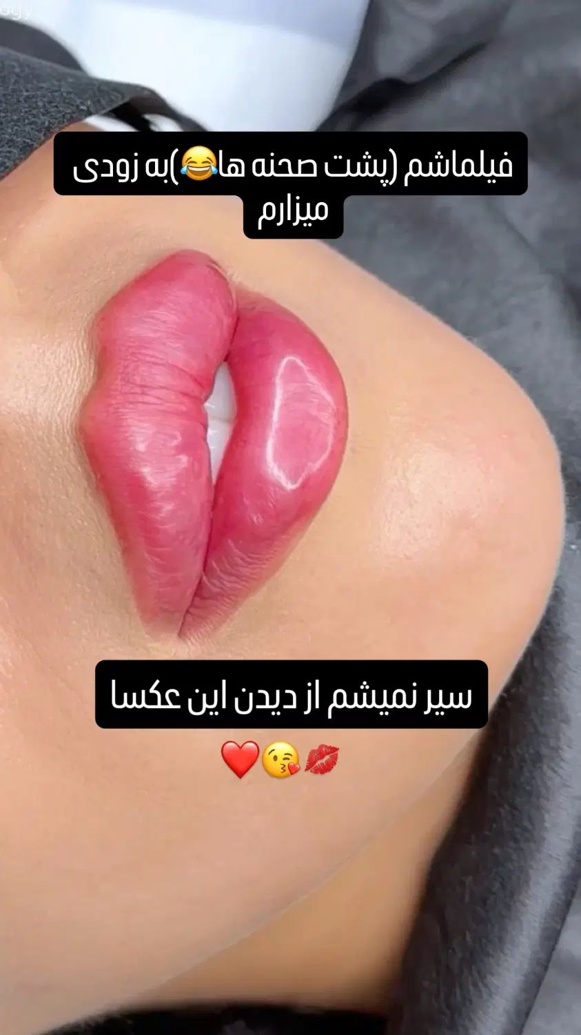 ژل فیلر  زاویه سازی لیفت هایفو بلفارو مزو آنزیم|خدمات آرایشگری و زیبایی|مشهد, هفت تیر (حافظ)|دیوار