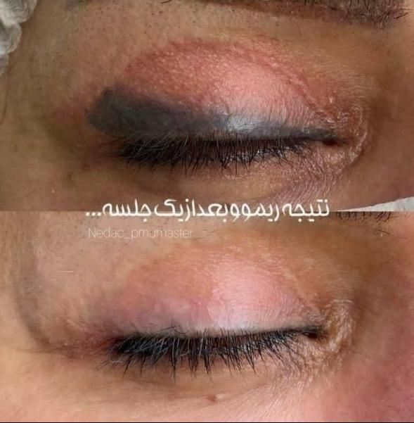 لـیزر موهای زائد/الکساندرایت/پی ار پی/پاککردن تاتو|خدمات آرایشگری و زیبایی|مشهد, آزادشهر|دیوار