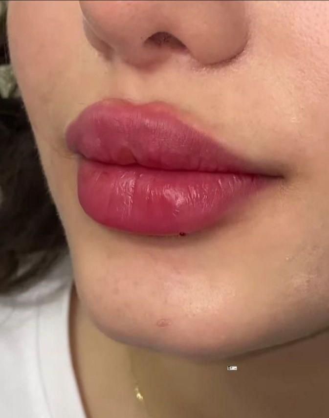 آموزش ژل بوتاکس نخ مدل پزشک هایفو آنزیم مزوتراپی|خدمات آرایشگری و زیبایی|تهران, ستارخان|دیوار