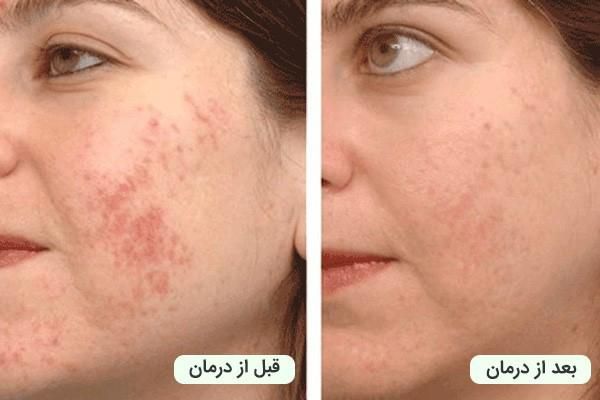لیزر پاک کردن تتو کیوسوییچ|خدمات آرایشگری و زیبایی|اهواز, کیانپارس |دیوار
