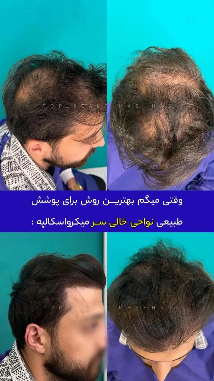 رفع کمپشتی مو با تکنیک میکرو اسکالپ /مکمل کاشتمو|خدمات آرایشگری و زیبایی|مشهد, احمدآباد|دیوار
