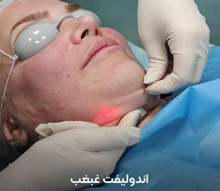 اندولیفت/ جوانسازی /تخلیه چربی صورت / رفع سلولیت|خدمات آرایشگری و زیبایی|تهران, صادقیه|دیوار
