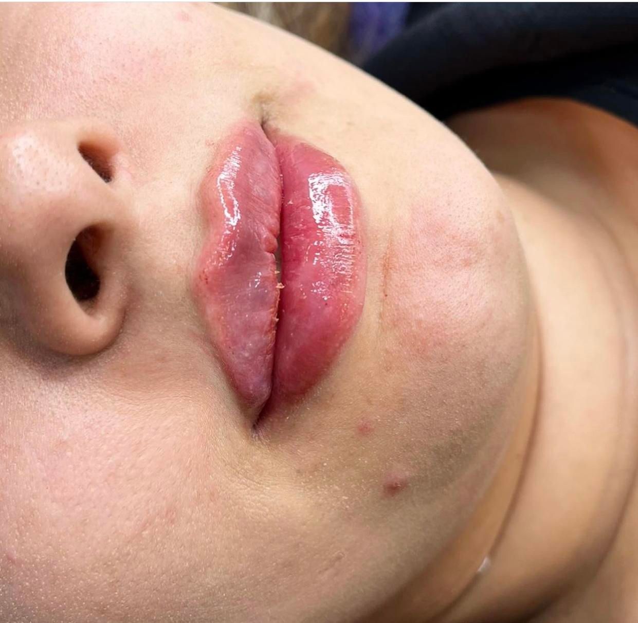 تزریق ژل و بوتاکس،فیلر بدن و لیفت با نخ|خدمات آرایشگری و زیبایی|کیش, |دیوار