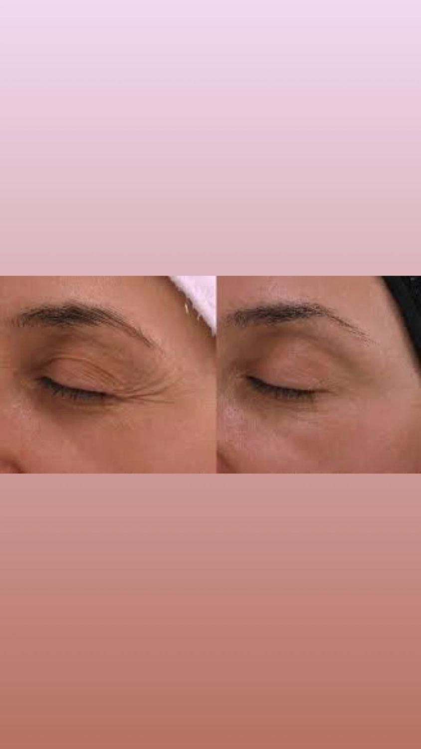 بوتاکس فقط ۹۵۰ ( پیشانی لبخند لثه ای زیر بغل و..)|خدمات آرایشگری و زیبایی|محمدیه-قزوین, |دیوار