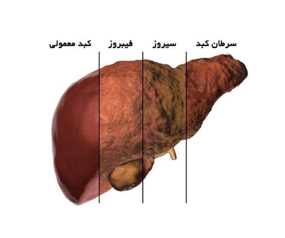 کبد چرب|آرایشی، بهداشتی، درمانی|اردبیل, |دیوار