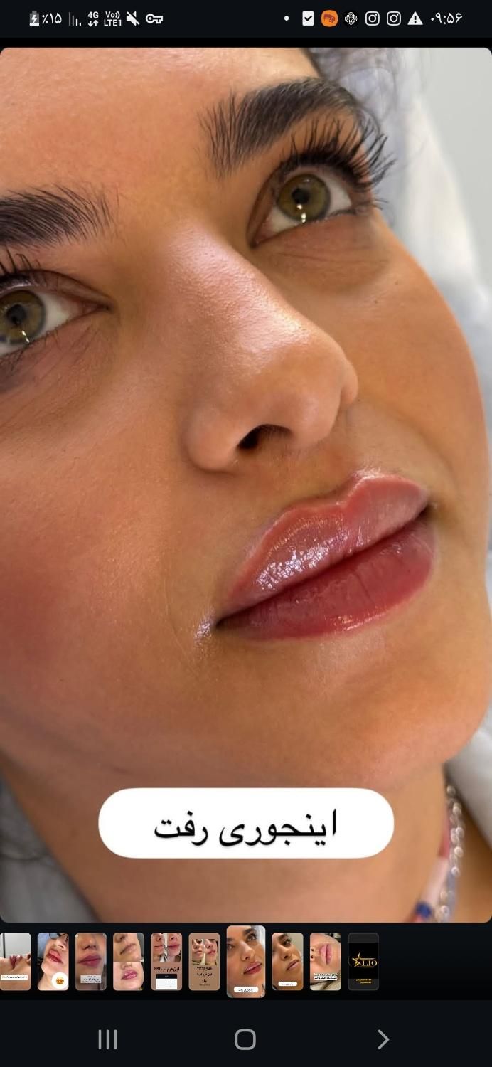 تزریق ژل و بوتاکس توسط پزشک|خدمات آرایشگری و زیبایی|بروجرد, |دیوار