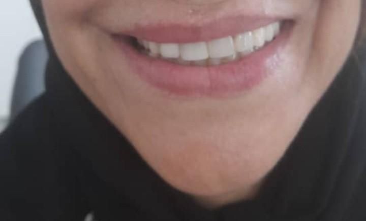 ساخت دندان مصنوعی فلیپر (تک واحدی و دو واحدی)|خدمات آرایشگری و زیبایی|آمل, |دیوار