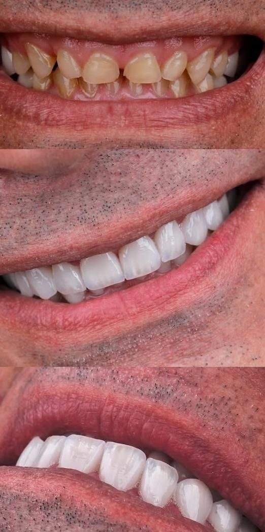 کامپوزیت فیسینگ ارتودنسی بزرگسالان و کودکان بیهوشی|خدمات آرایشگری و زیبایی|شیراز, زرگری|دیوار