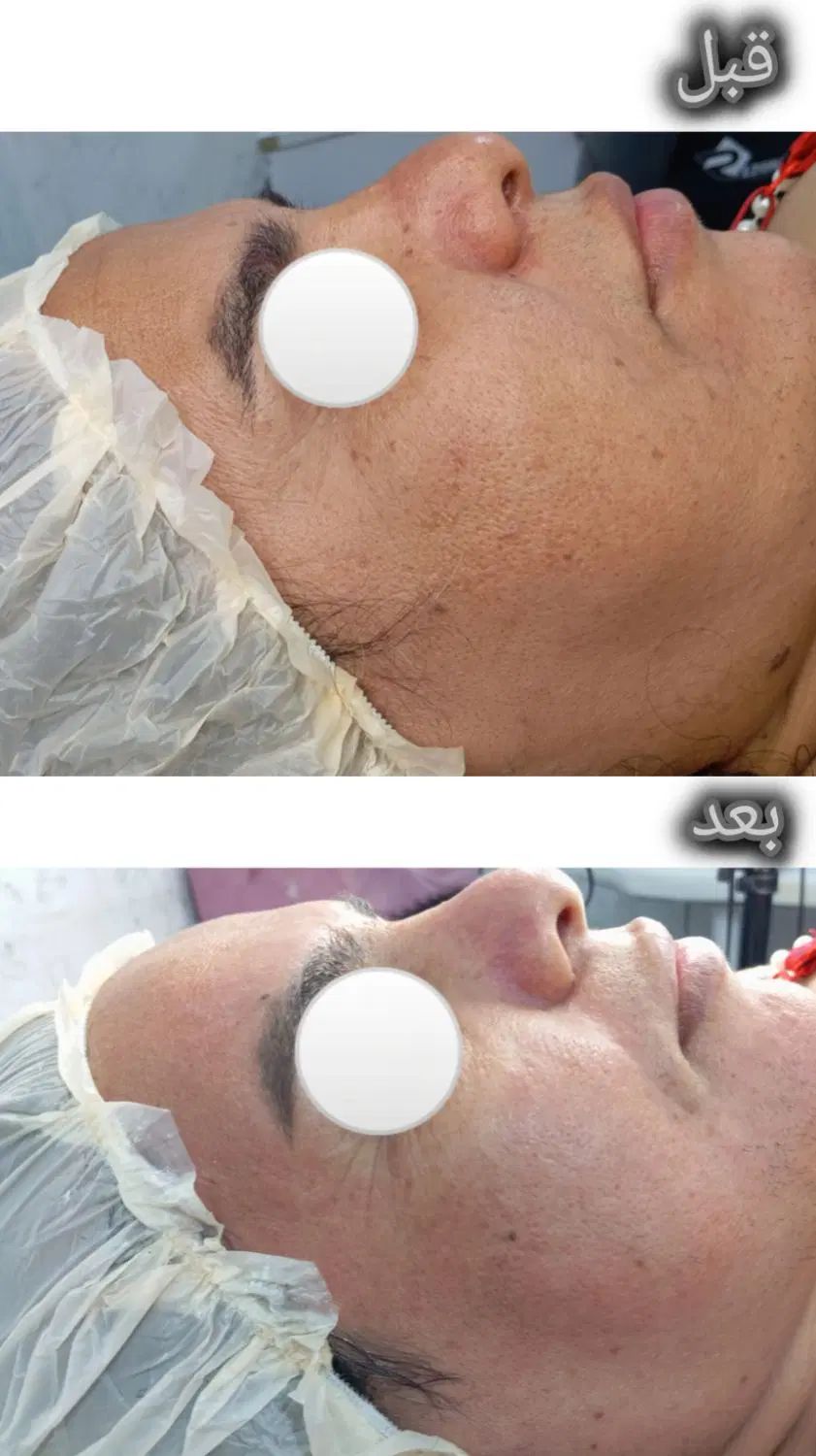 مدل برای روشن سازی صورت و از بین بردن جوش|خدمات آرایشگری و زیبایی|مسجد سلیمان, |دیوار