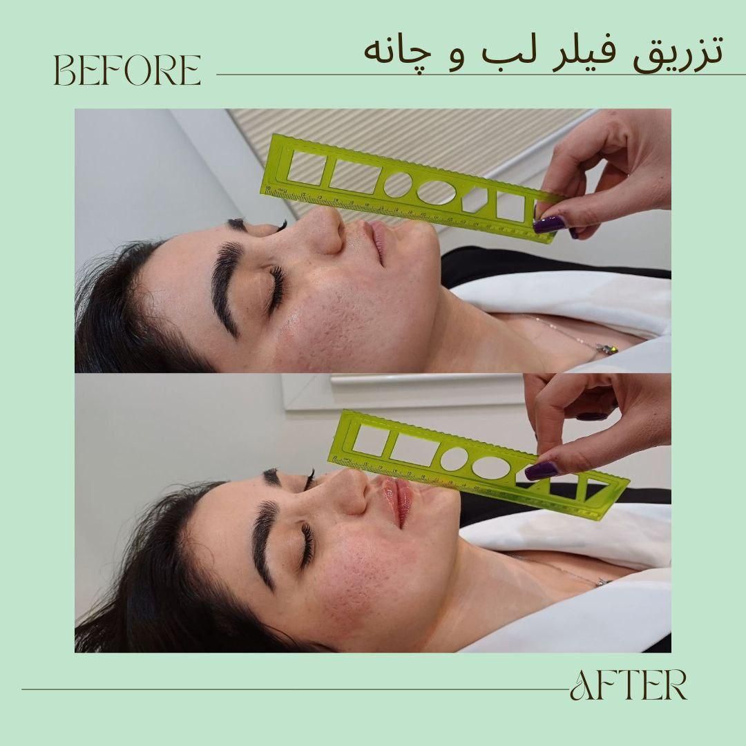 تزریق ژل بوتاکس فیلر چشم هایفو مزو جوانساز زاویه|خدمات آرایشگری و زیبایی|تهران, هفت حوض|دیوار