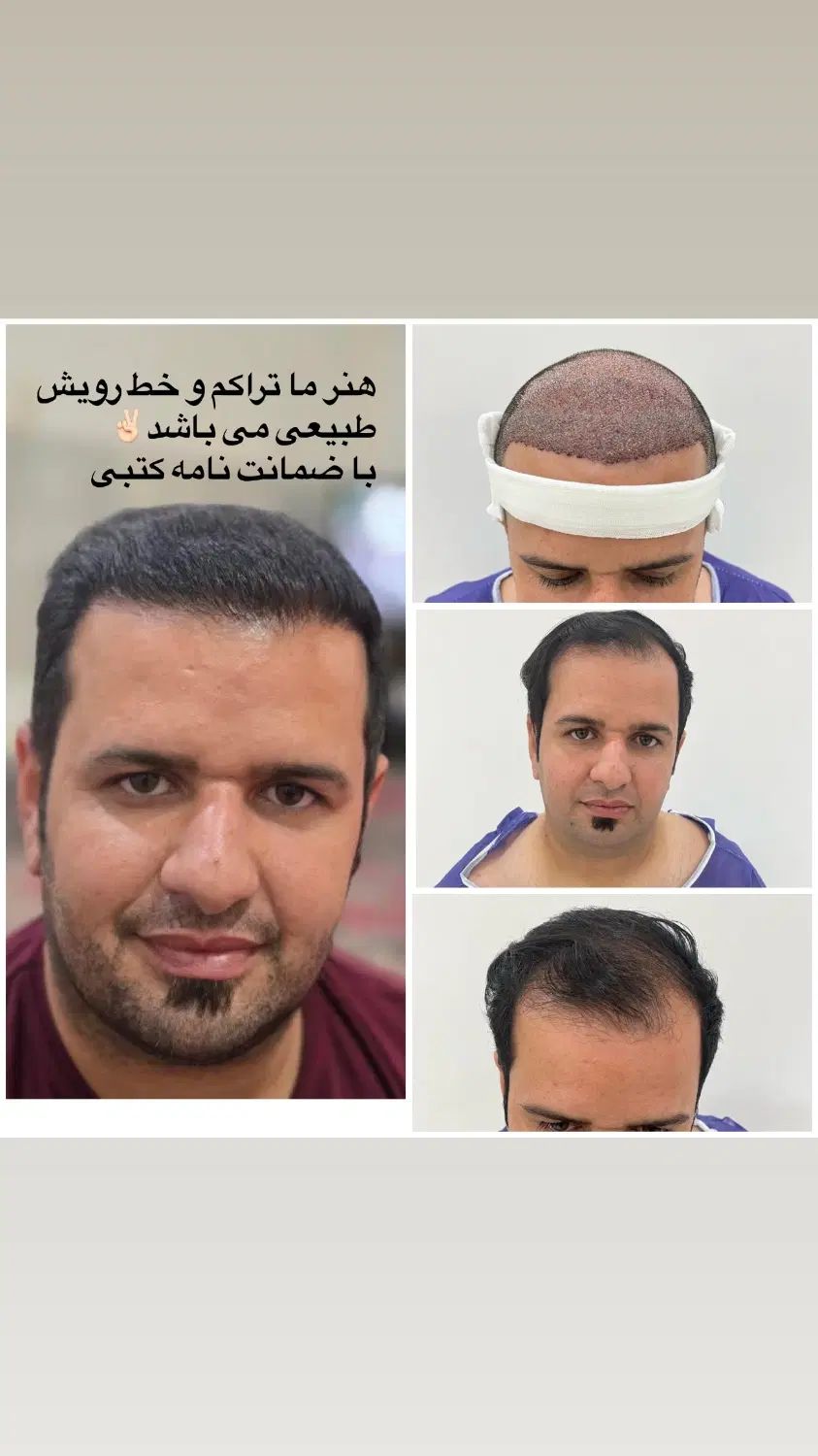 کاشت مو شیرازی،معجزه ی ما تراکم  هنر ما خط رویش|خدمات آرایشگری و زیبایی|یزد, |دیوار