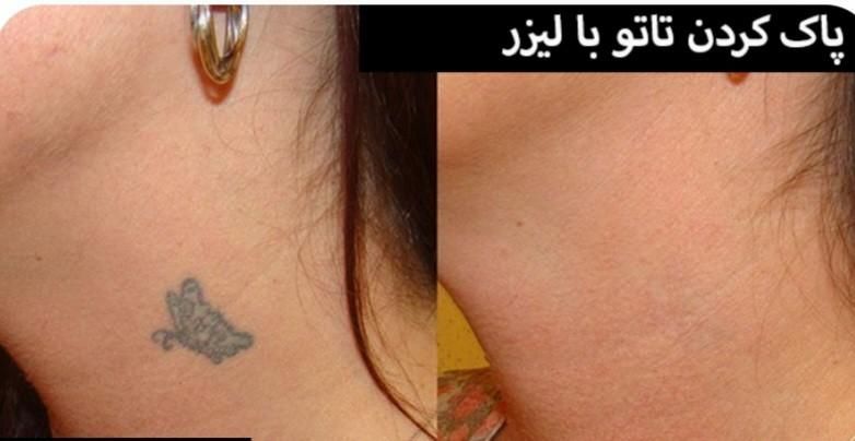 پاک کردن تتو بالیزر بدون آثار سوختگی در تالش|خدمات آرایشگری و زیبایی|تالش, هشتپر|دیوار