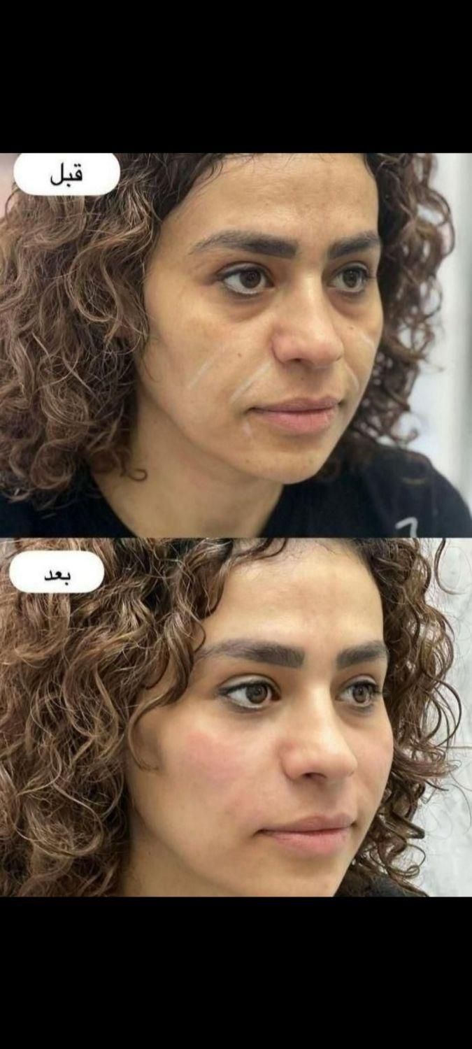 خدمات ژل وبوتاکس /کاشت مووابرو/باکمترین قیمت|خدمات آرایشگری و زیبایی|خرم‌آباد, |دیوار