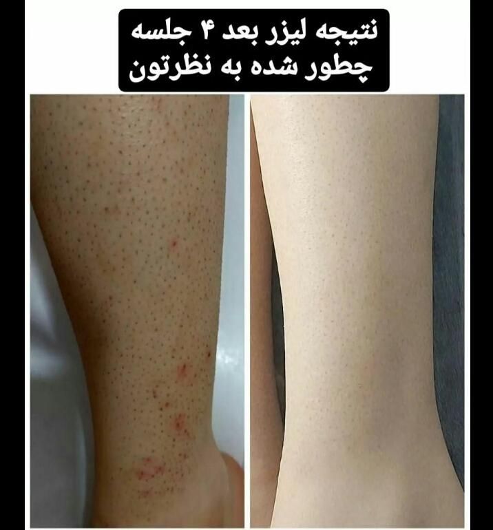 لیزر موهای زائد ریزش مو۱۰۰درصدو فیشال پوست(تضمینی)|خدمات آرایشگری و زیبایی|اهواز, گلستان|دیوار