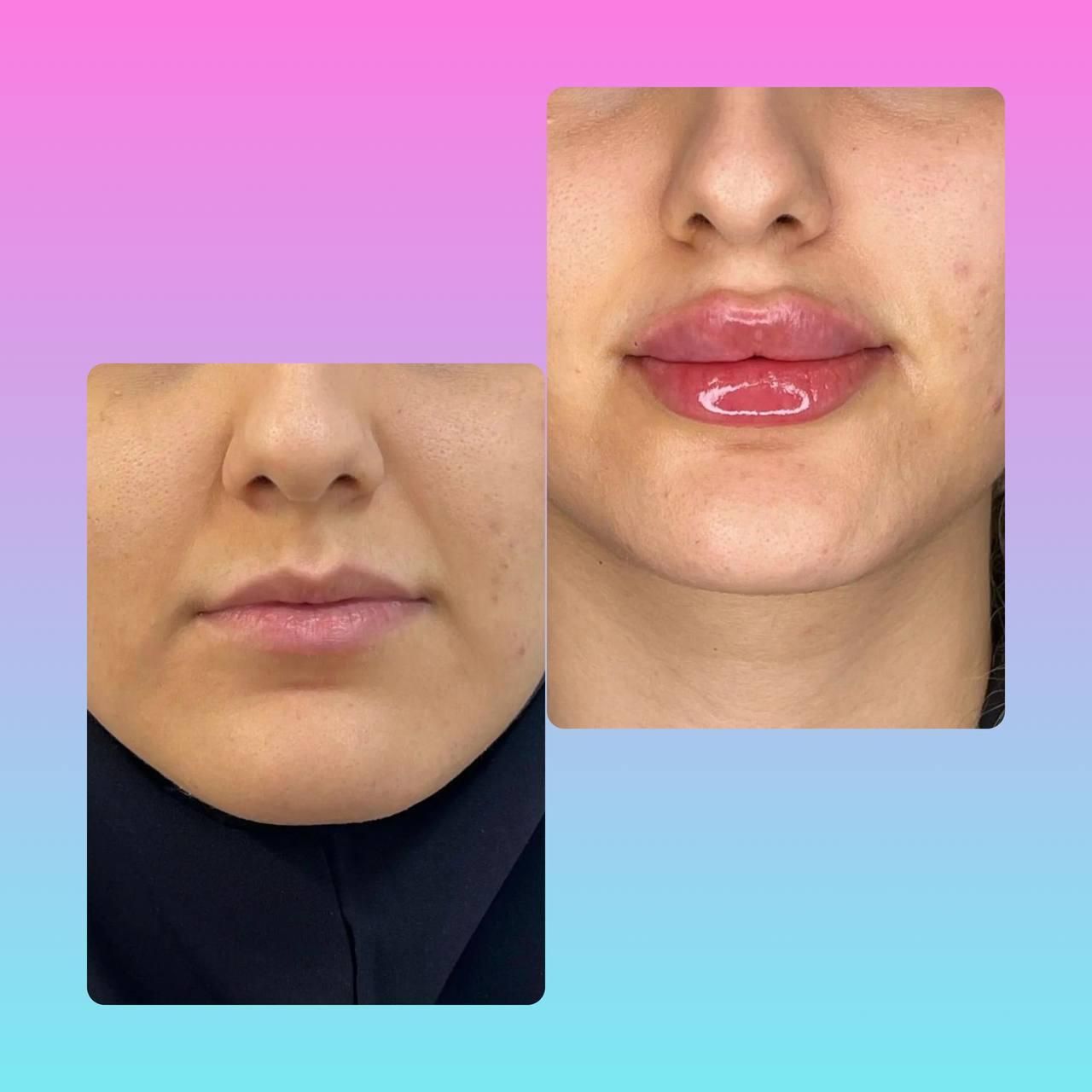 بوتاکس،لیزر،ژل،نخ گذاری و هایفودکتر شهبازی|خدمات آرایشگری و زیبایی|یزد, |دیوار