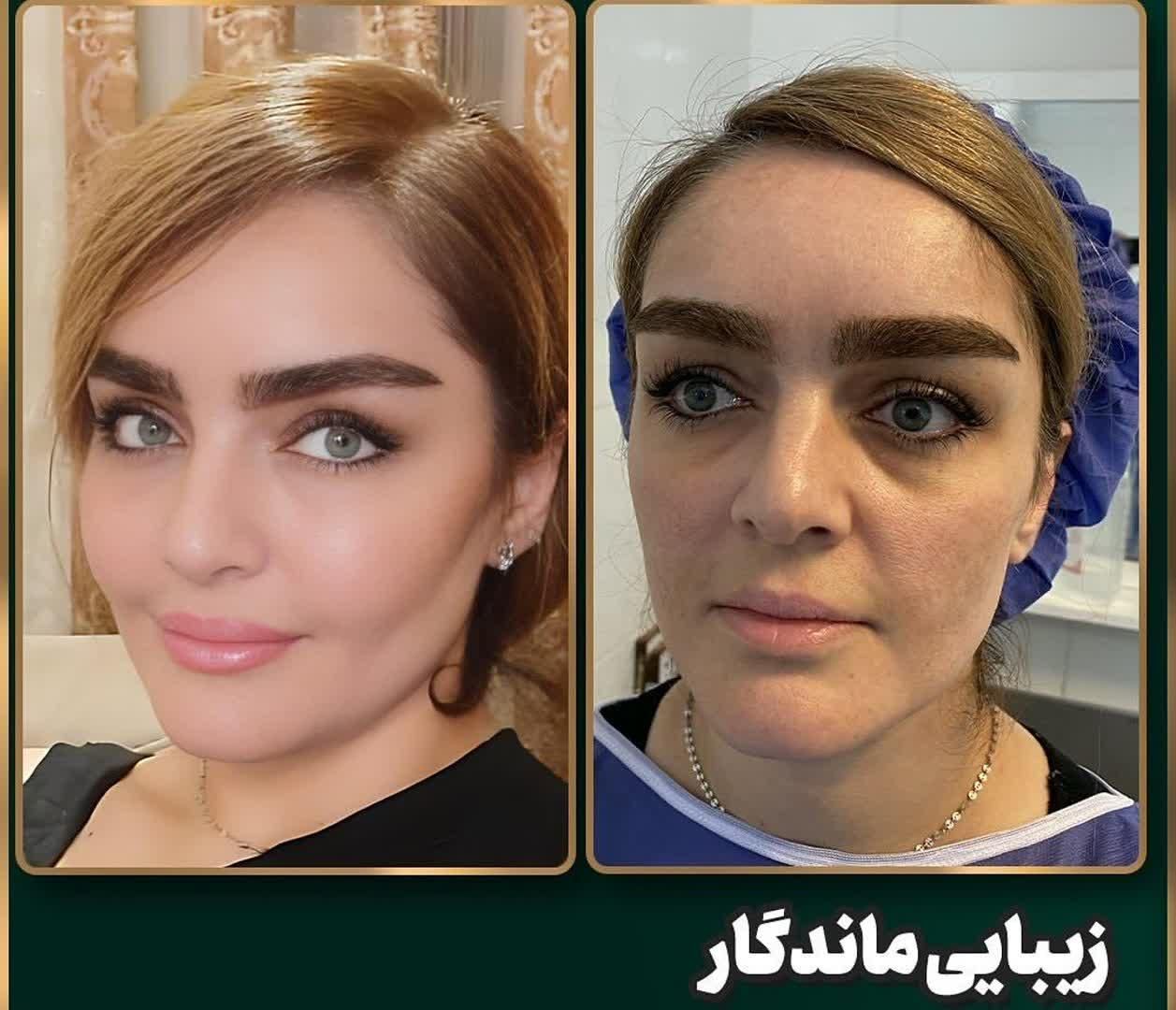 تزریق چربی بوکال فت کاشت مو ساکشن غبغب بلفاروپلاسی|خدمات آرایشگری و زیبایی|اصفهان, ملک‌شهر|دیوار