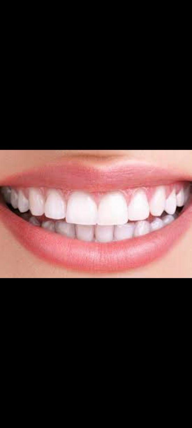 تخفیف ۹ میلیونی دندان برای کامپوزیت|اسکان اضطراری|کازرون, |دیوار