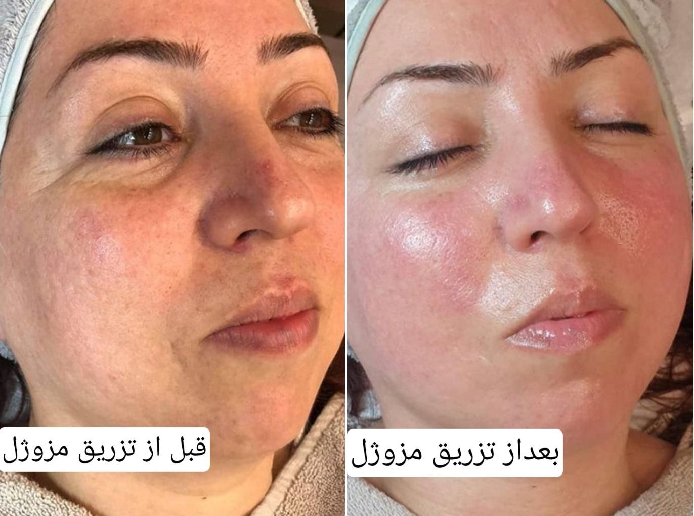 تزریق مزوژل روشن‌کننده جوانساز وبوتاکس|خدمات آرایشگری و زیبایی|آبادان, |دیوار