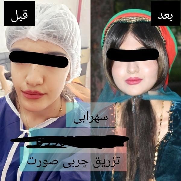 تزریق چربی صورت|خدمات آرایشگری و زیبایی|یاسوج, |دیوار