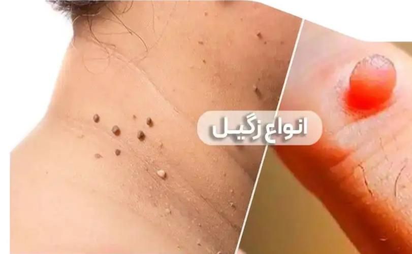 برداشتن انواع خال زگیل نشانه با مواد گیاهی تضمینی|خدمات آرایشگری و زیبایی|کرمانشاه, |دیوار